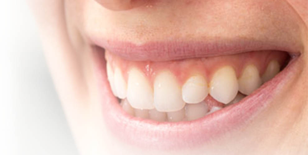 Benefits Of Fillings
